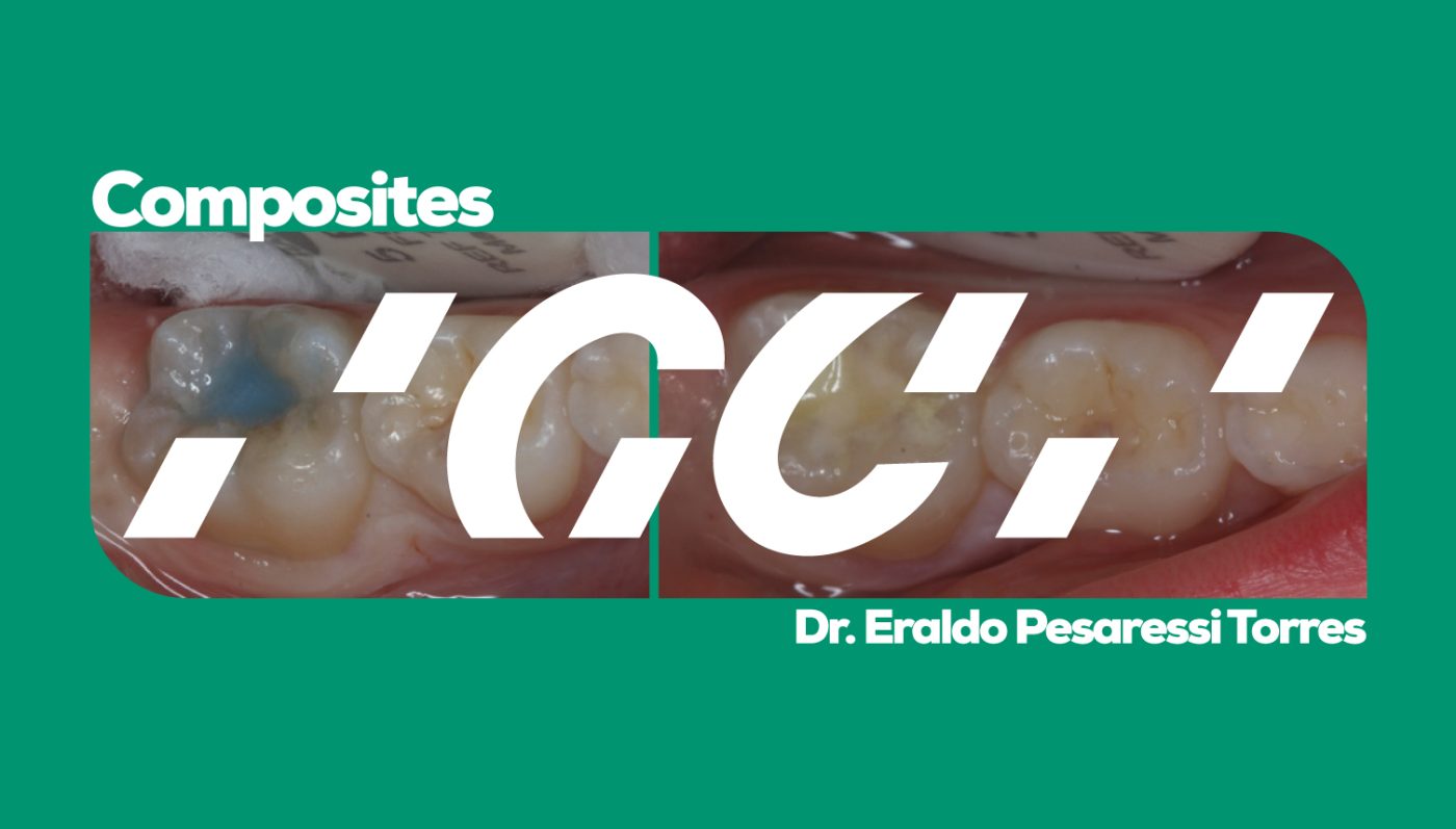 Artículo GC Restauraciones Directas